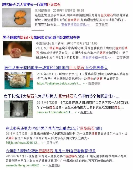 9岁体内取出巨大结石,大爷体内取出15厘米结石上海