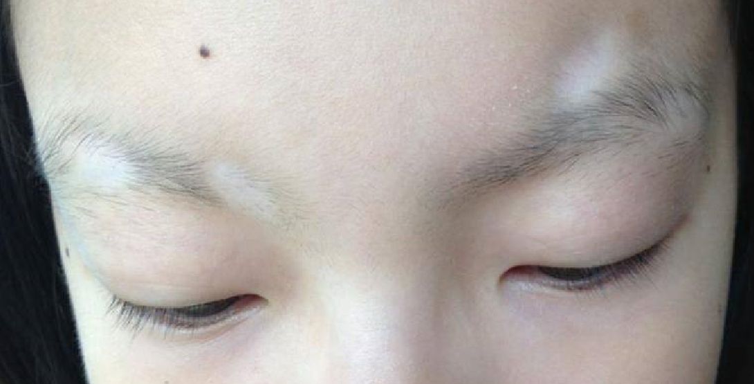 患上“拔毛癖”，18岁女大学生拔光眉毛