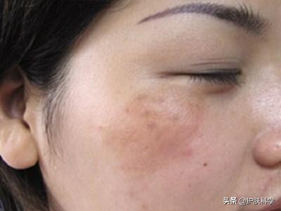 脸上长斑怎么办快速解决方法,脸上长黑斑怎样才能最快消除斑