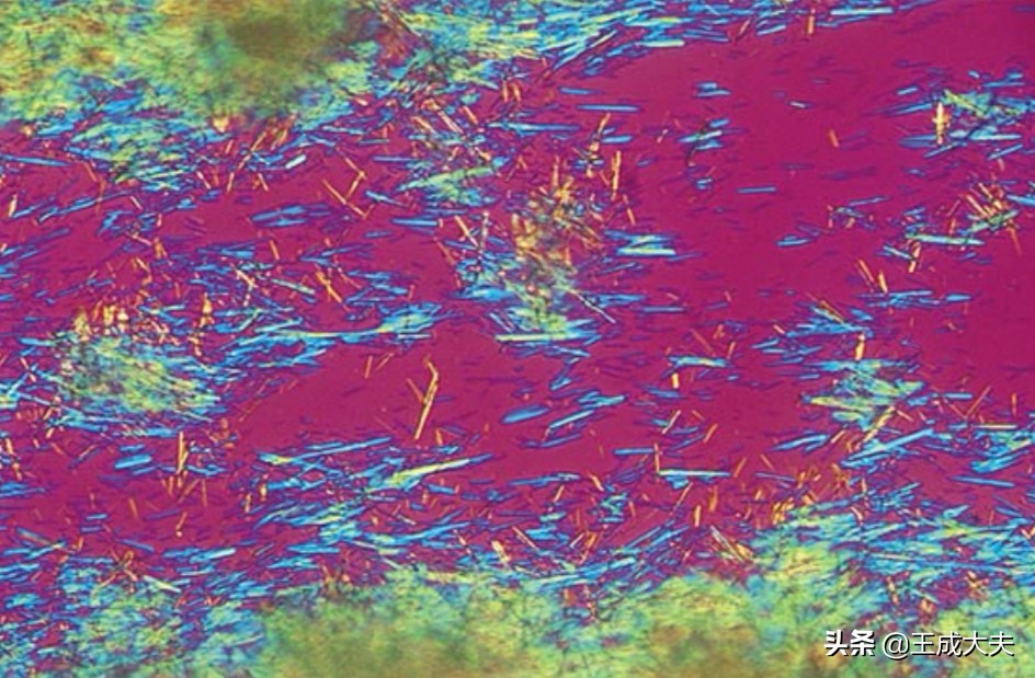 我在美国治痛风颠覆国人的想象,美国说2030有望攻克痛风