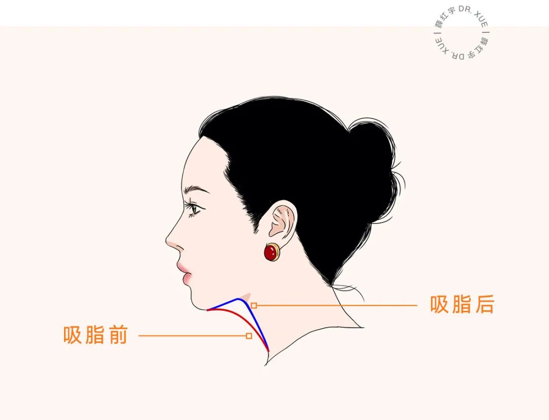 让下颚越来越清晰,下颌缘不清晰的原因