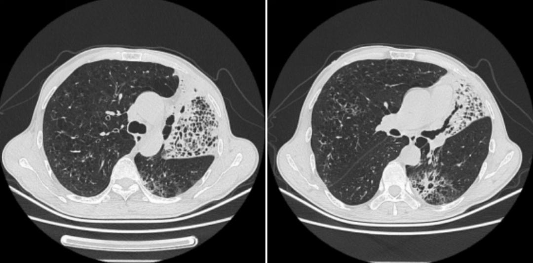 时隔一年再次住院,时隔一年旧病复发