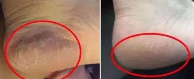 冬季皲裂膏预防脚后跟干裂好用的,上热门脚后跟干裂保湿霜