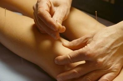 针灸对脑梗死的功效与作用,脑梗死中医辨证针灸治疗