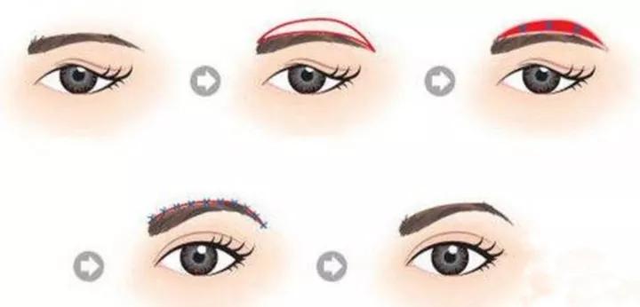 提眉手术的最佳方法图解,提眉手术有几种方法