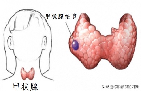 为什么女性更容易患甲状腺结节,女性甲状腺结节最怕吃什么食物