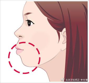 怎样判断龅牙是牙性还是骨性,怎么判断是牙性龅牙还是骨性龅牙