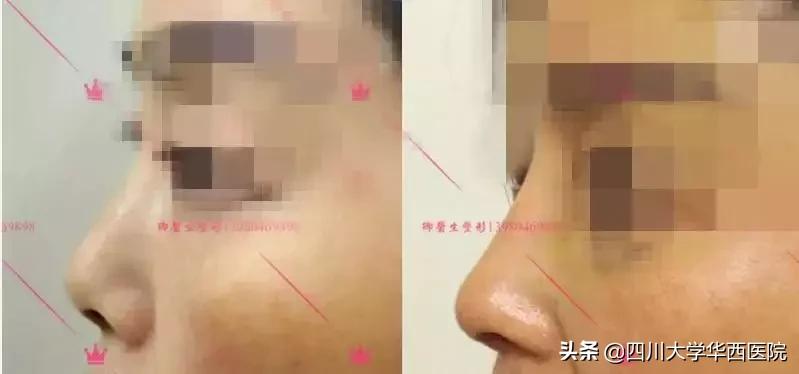 鼻子特别大怎么修,鼻子大如何修鼻子