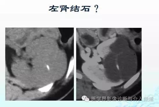 增强ct碘过敏该用什么造影剂,加强ct造影剂过敏皮疹多久能恢复
