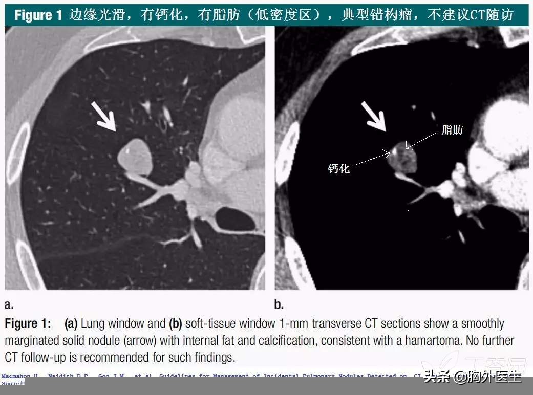 肺结节属于什么肺病,肺结节是什么病需要做化疗吗