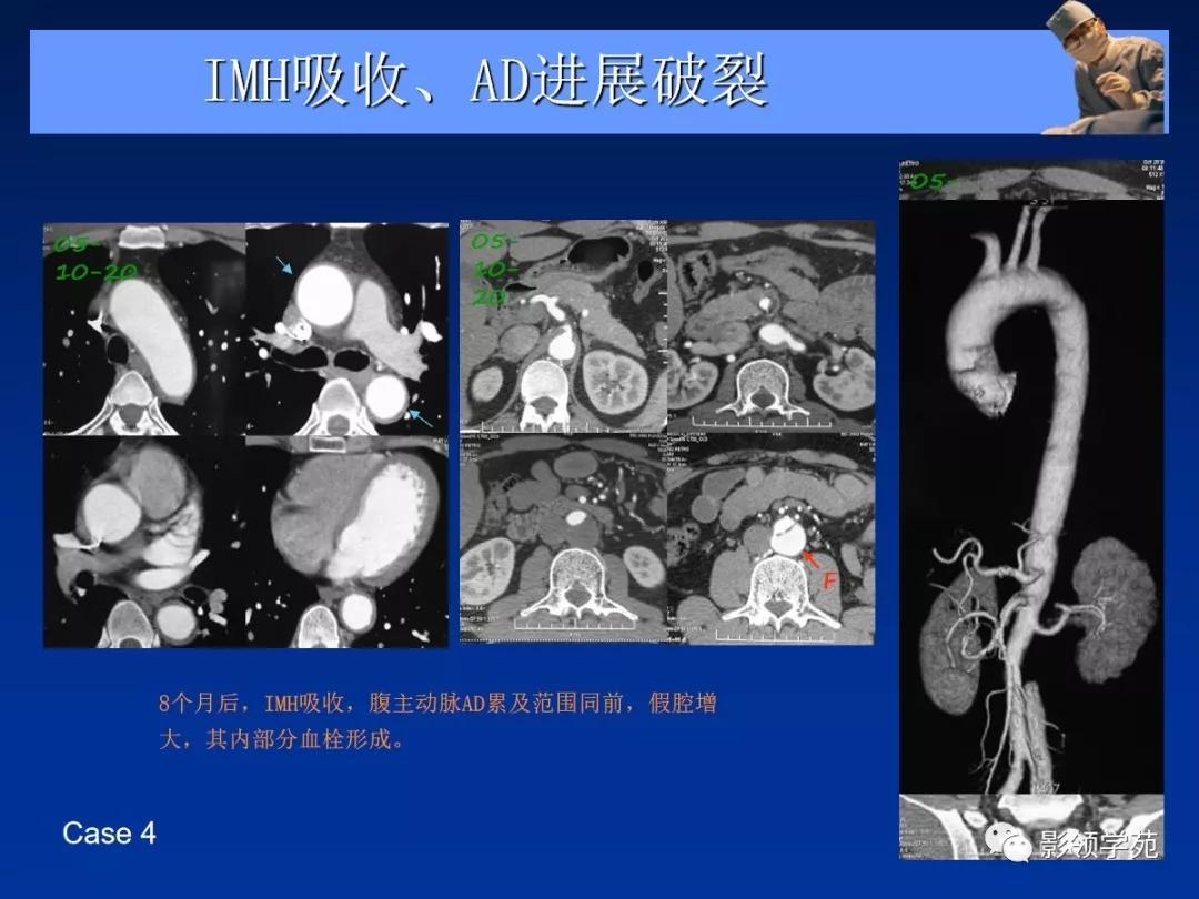 主动脉夹层壁间血肿如何鉴别,主动脉夹层血肿溃疡