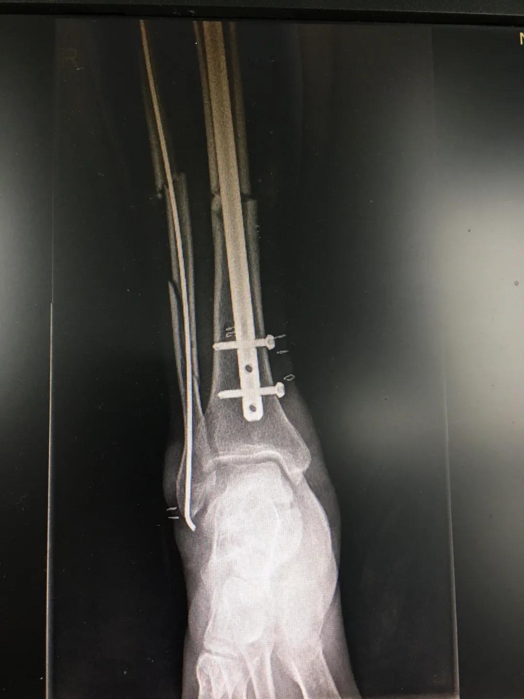 小腿骨断成三截了还能恢复吗,小腿断了三截能好彻底吗