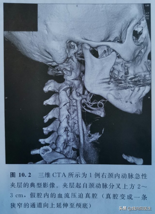 颈动脉闭塞血管夹层,颈动脉夹层是什么原因形成的