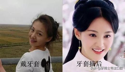 明星牙齿矫正前后对比,明星牙齿矫正都用的什么矫正方式