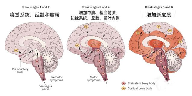 帕金森睡眠障碍怎么康复训练,怎样改善帕金森的运动状态