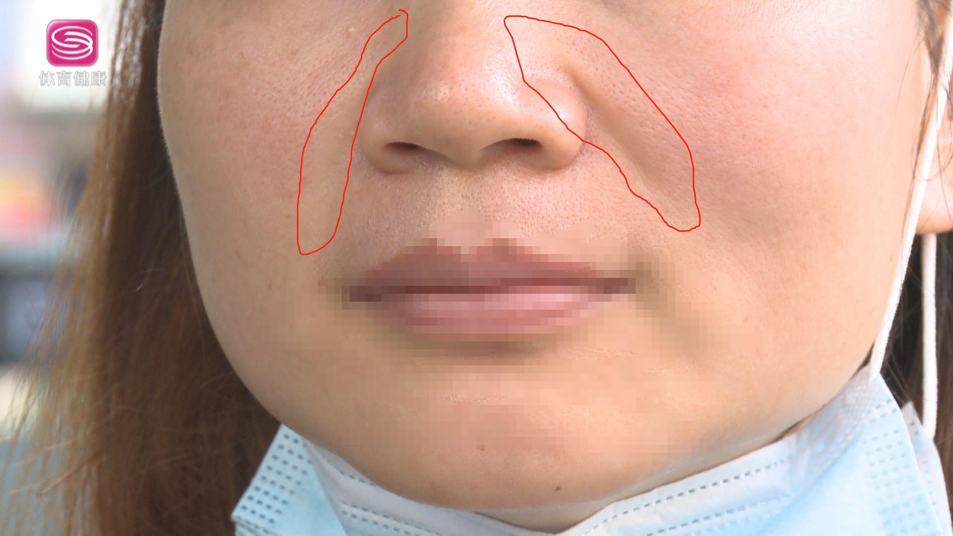 改善法令纹需要做小拉皮吗,原来淡化法令纹这么简单