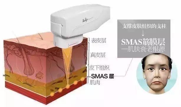 超声刀和热玛吉哪个提升效果好,超声刀和埋线提升哪个效果好