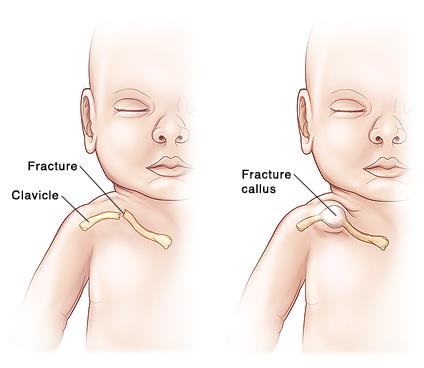 新生儿锁骨骨折原因有哪些,新生儿锁骨骨折是怎么回事