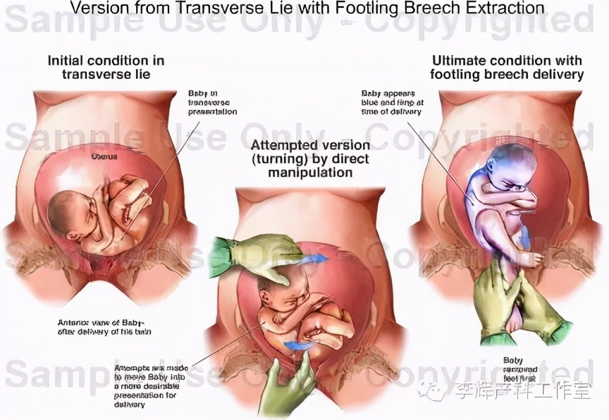 剖宫产憩室手术知情同意书,剖宫产手术同意书