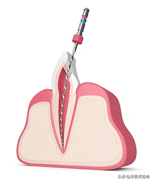 牙齿做了根管治疗能吃饭吗,牙齿做根管治疗后牙根会变色吗