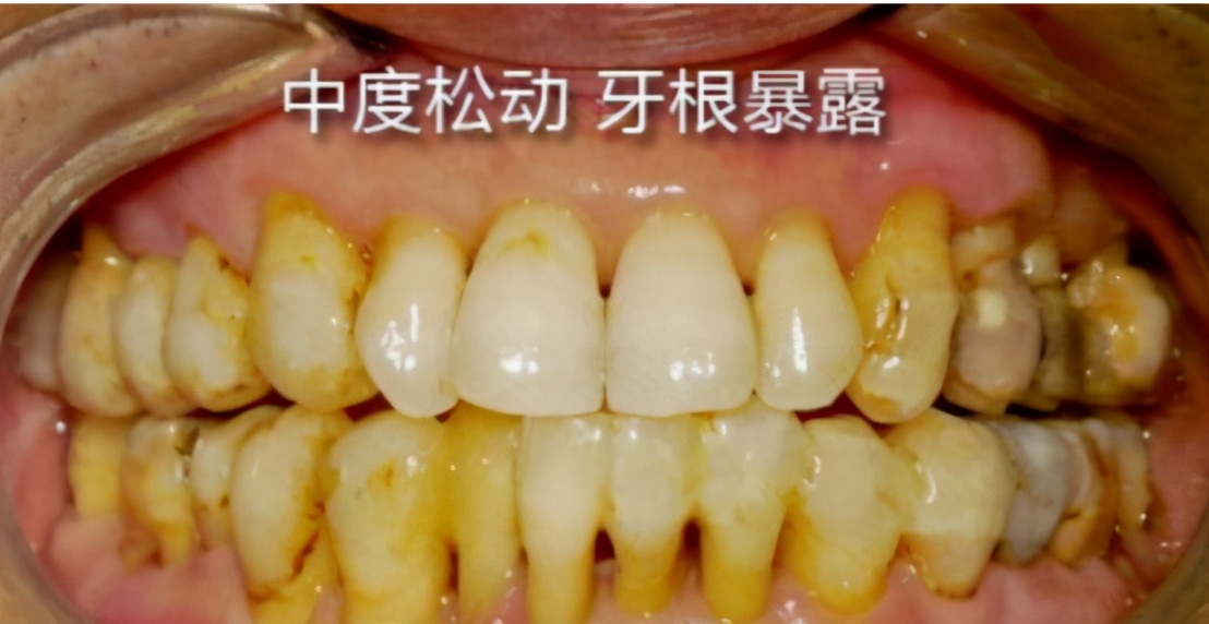 上海牙齿松动怎么修复,牙齿松动修复固齿医院