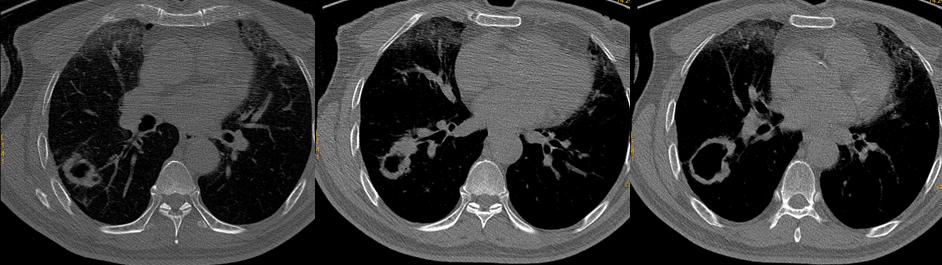 肺鳞癌介入治疗成功率,肺鳞癌最好的免疫化疗方案