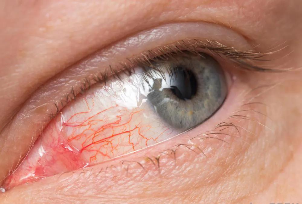 孩子的眼睛突然又红又肿怎么回事,眼睛肿了去医院挂什么科