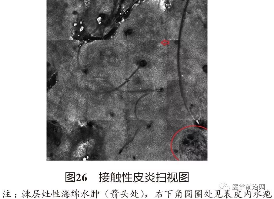 炎症性皮肤病反射式共聚焦显微镜诊断特征专家共识全文发布