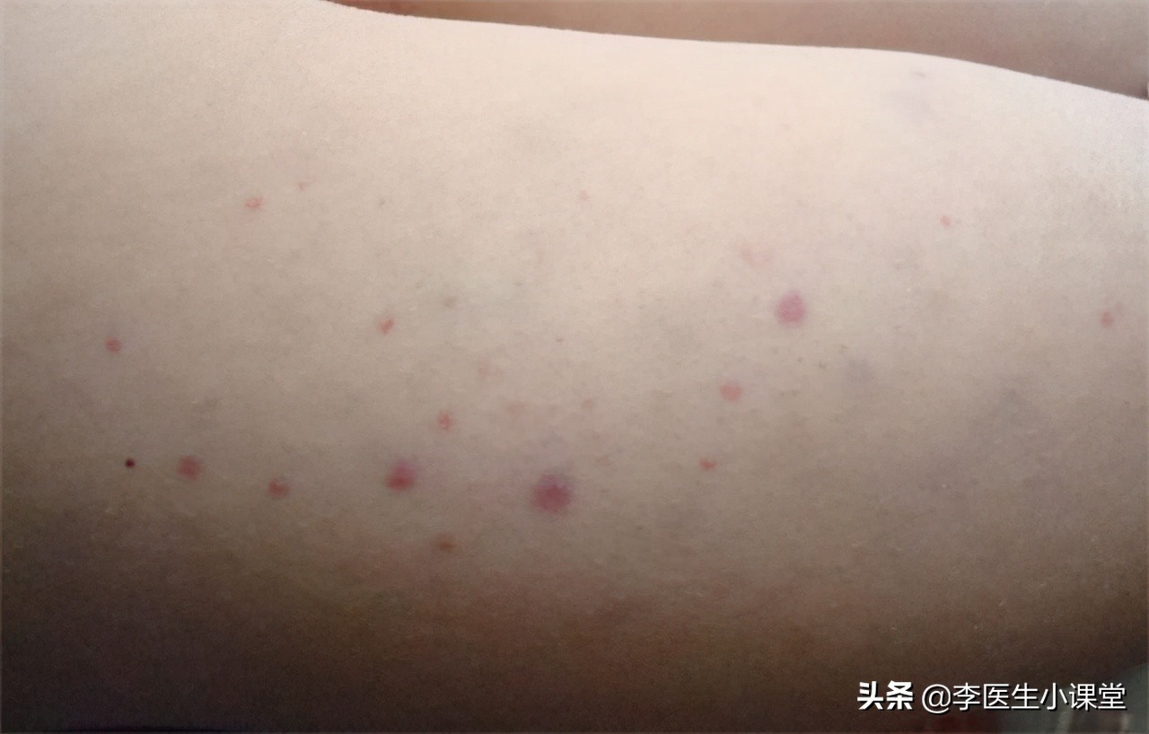 恶性肿瘤能打针吗,恶性肿瘤患者可以打破伤风吗