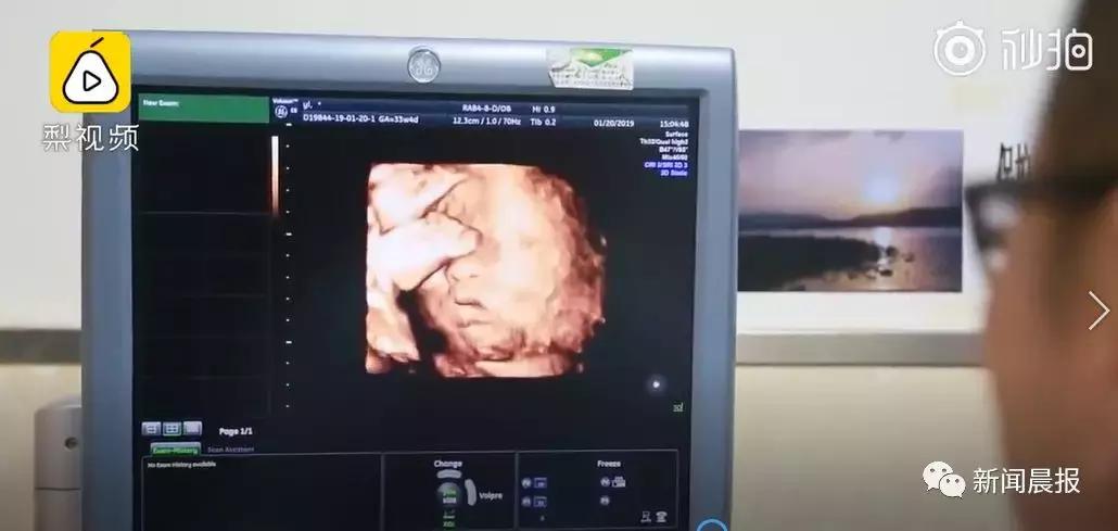 “借”母亲子宫,女子成功生下自己的宝宝网友:男人生娃岂不是指日可待!