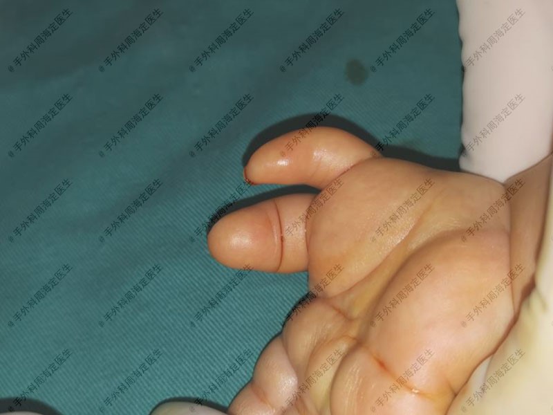 宝宝一出生手就比较大,宝宝一出生手掌就比别的宝宝大