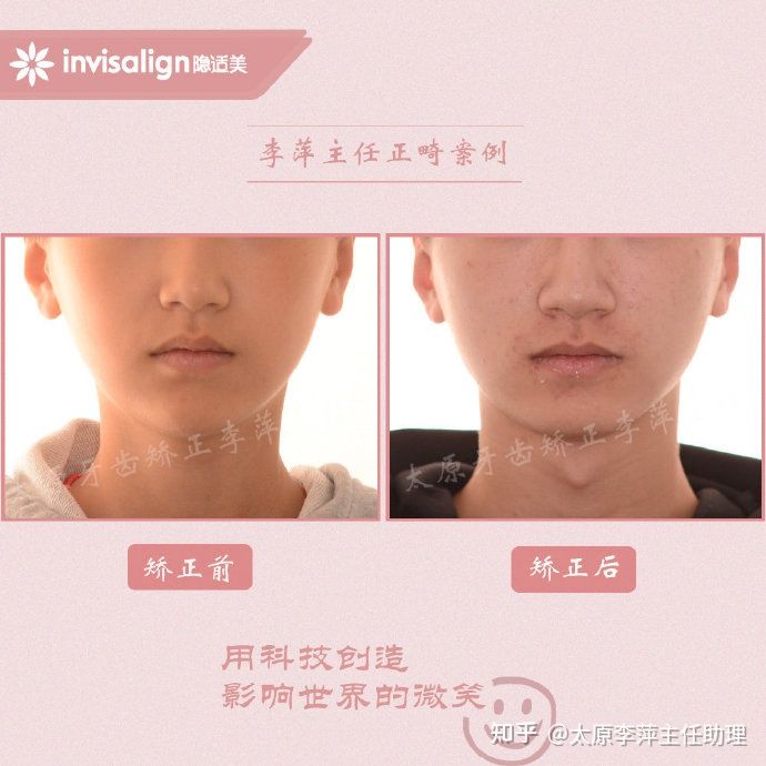 重度拥挤矫正牙齿适合隐形牙套吗,广州成人牙齿矫正推荐隐形牙套