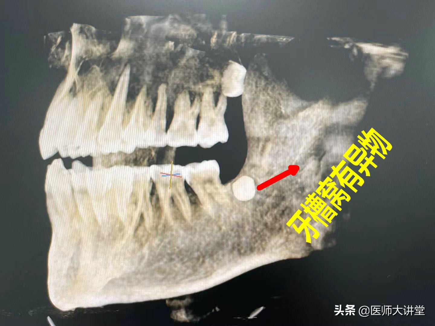 探讨56岁刘大姐拔除立事牙15天后疼痛肿胀的原因分析