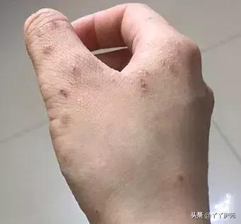 夏季湿疹高发期，如何用药是关键