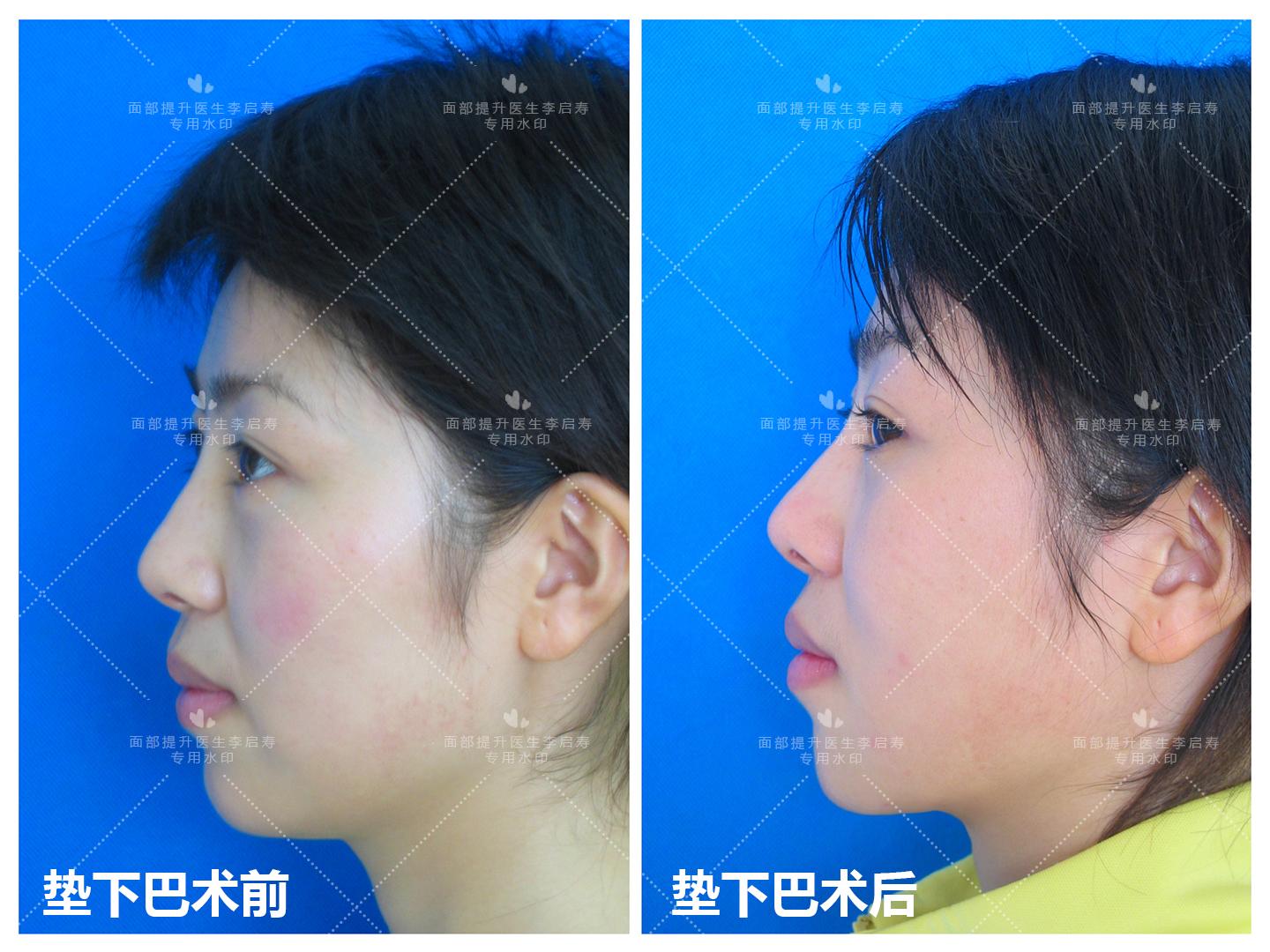 谈谈自己的整形经历,整形过来人经验分享