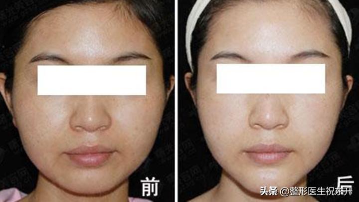 做完面部吸脂脸颊凹陷怎么办呀,吸脂后面部凹凸不平怎么办