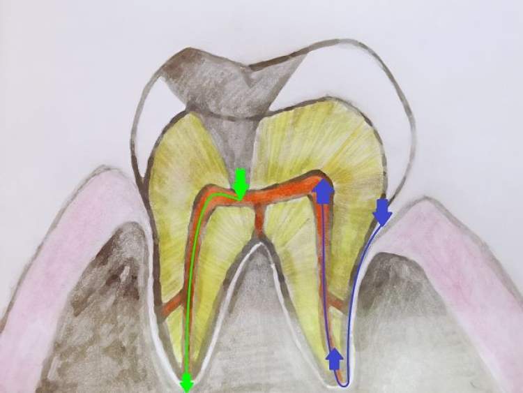 明明看不见蛀牙，却要接受根管治疗，究竟是怎么回事？