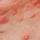 艾滋病窗口期皮肤瘙痒挠了会怎样,浑身皮肤瘙痒越挠越痒怎么解决