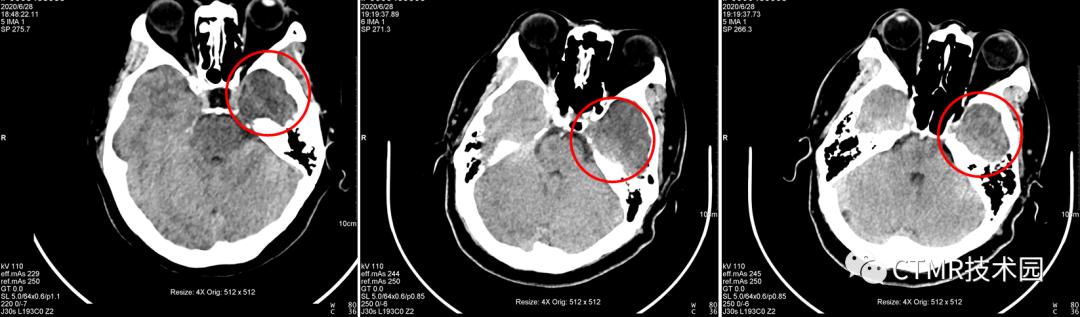 CT影像技术,脑部做ct有伪影是怎么回事