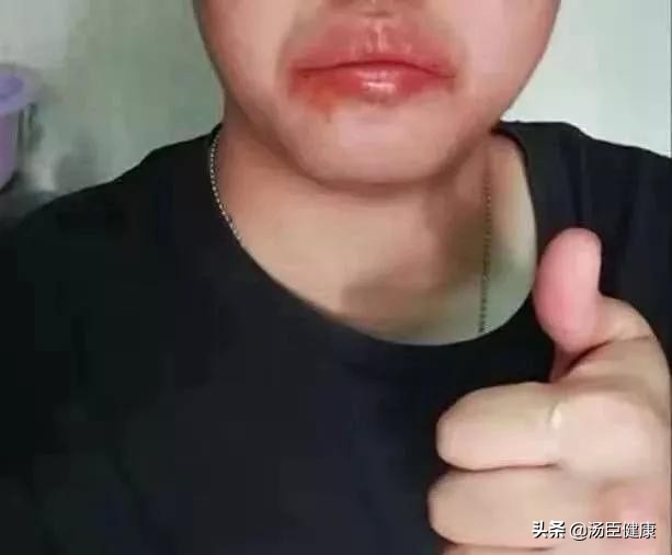 吃辣椒容易上火有什么办法解决,辣椒上火了吃什么能消除