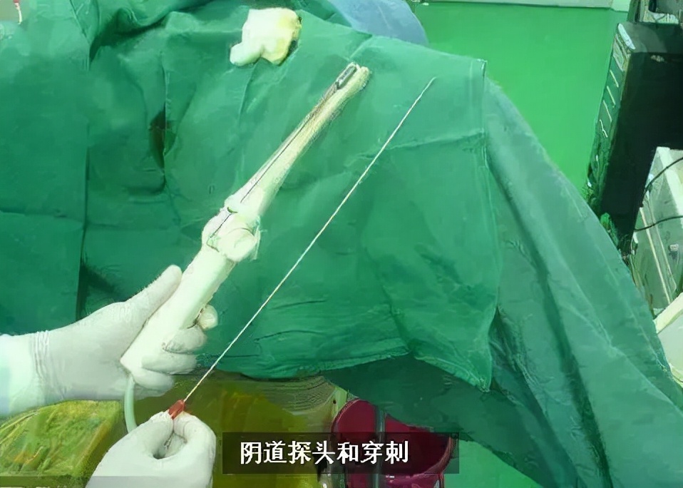 捐卵黑幕,捐卵骗局真人