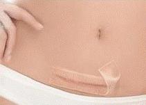 剖腹产难看的疤痕教你轻松美化,剖腹产疤痕恢复经历真实讲述