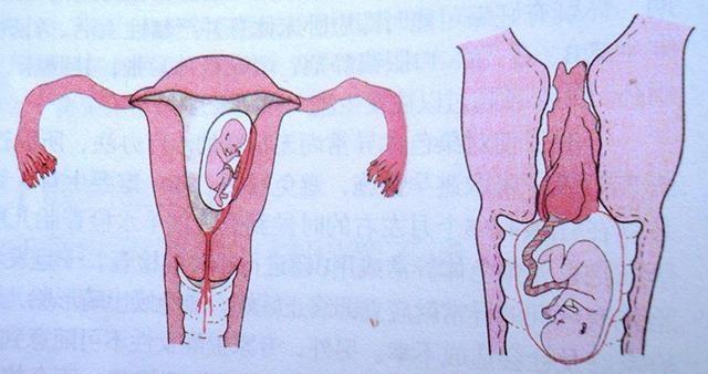 怀孕6个月胎盘低出血注意些什么,5到6周孕妇的注意事项
