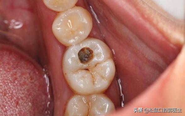 怎样判断自己有蛀牙,怎样判断自己有没有蛀牙