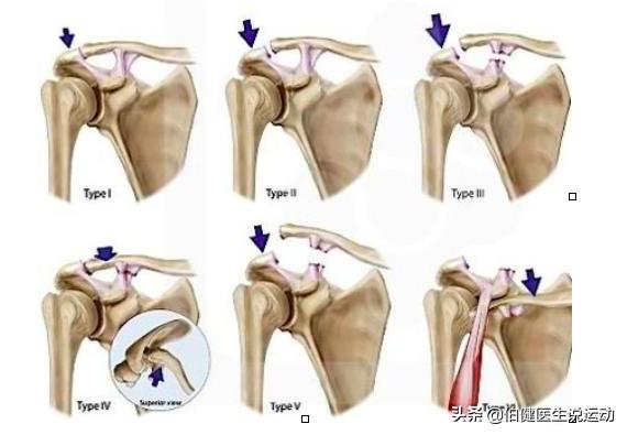 胳膊一动胸椎就咯噔咯噔响,肩锁关节脱位需要吊胳膊吗