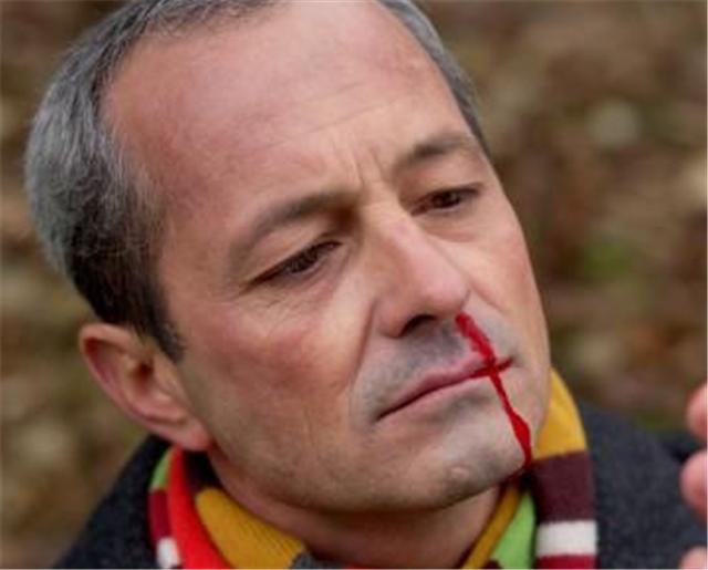 鼻咽癌治疗后前三个月复发征兆,鼻咽癌癌晚期死前24小时征兆