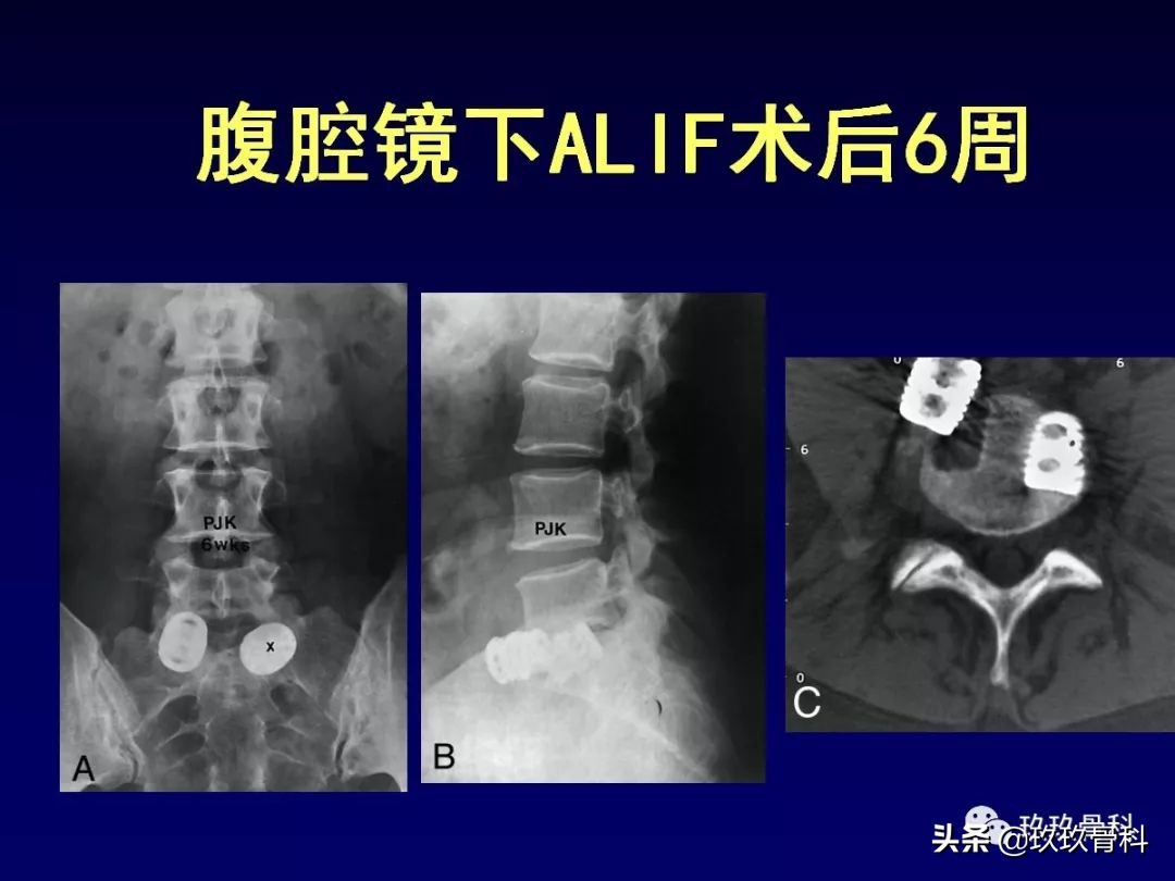 腰椎不稳最坏的结果,腰椎不稳的最佳治疗方法