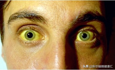 你了解黄疸吗,了解胆红素高是怎么回事