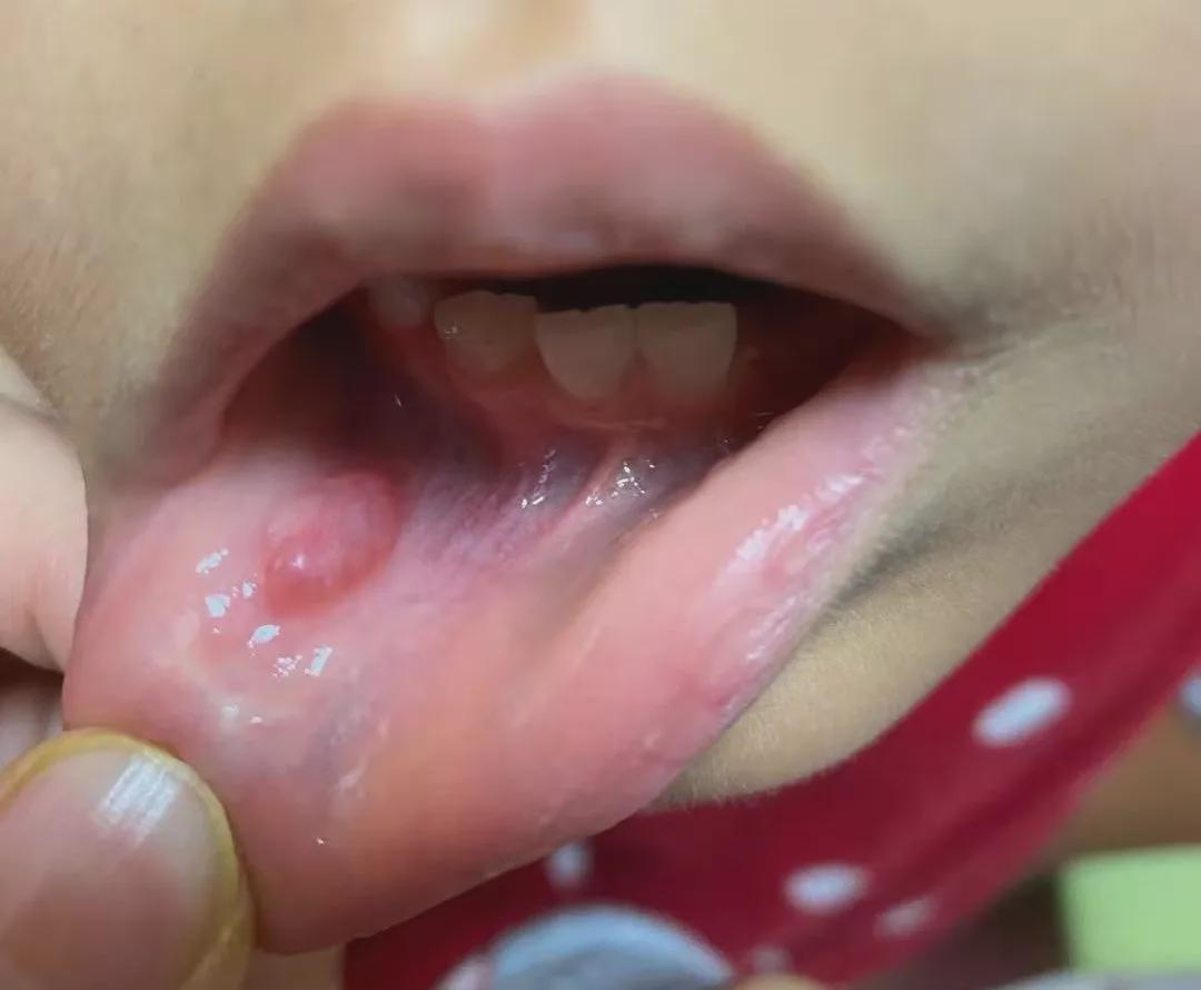 嘴里长了个小包一直不好怎么回事,嘴里长白色小包很痛怎么办