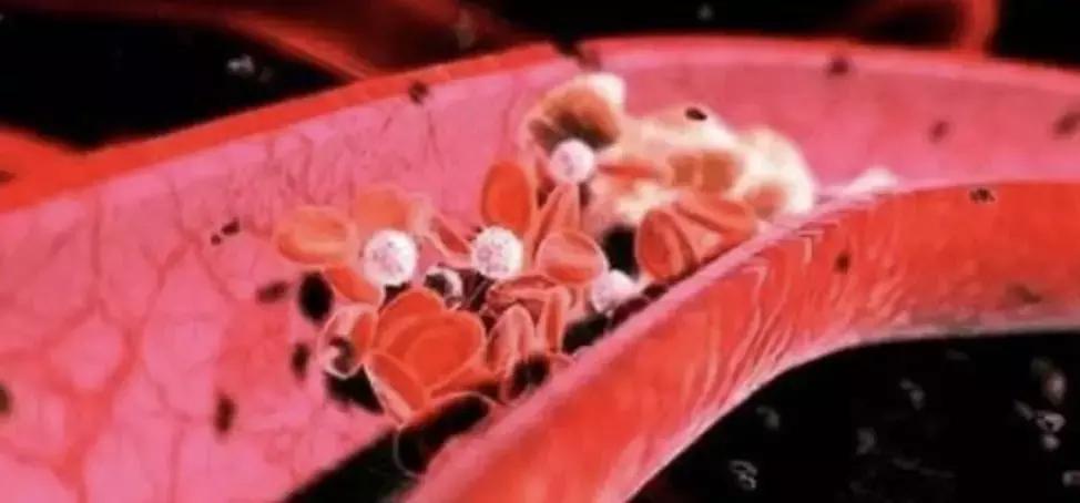 血管有杂质是什么症状,血管里有垃圾和毒素吗